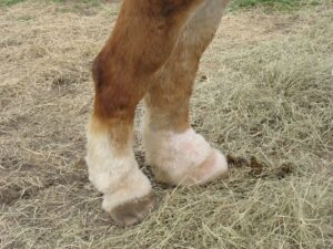 Lymphedema